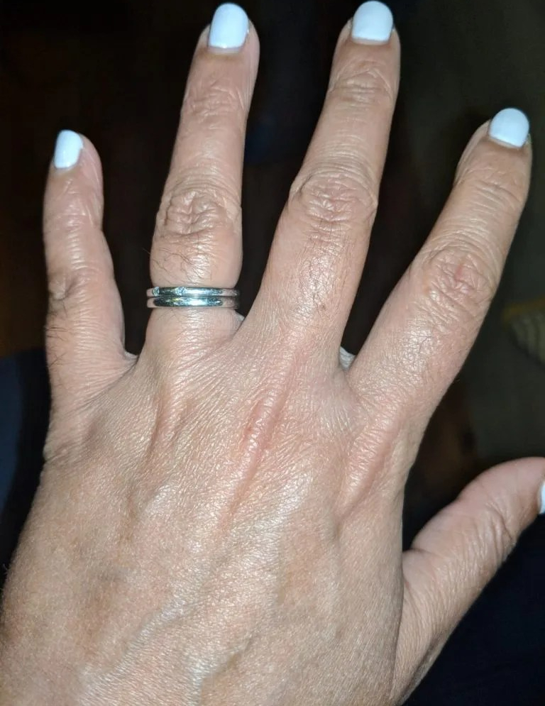 hand-after-5-months-of-treatment-with-naet-and-cst-and-nutrition-768x1024-after